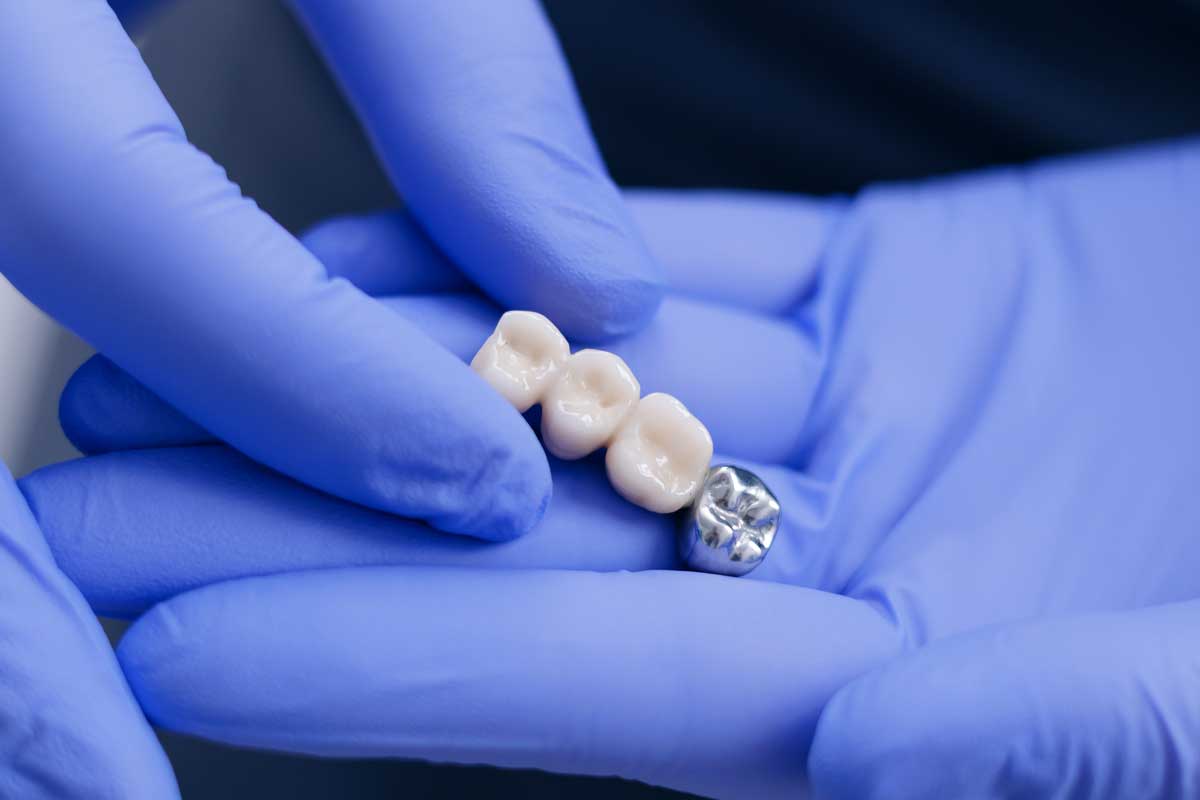 dental bridge