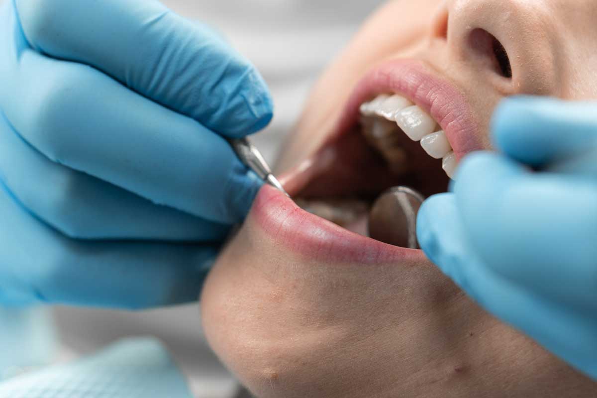 dental cleaning