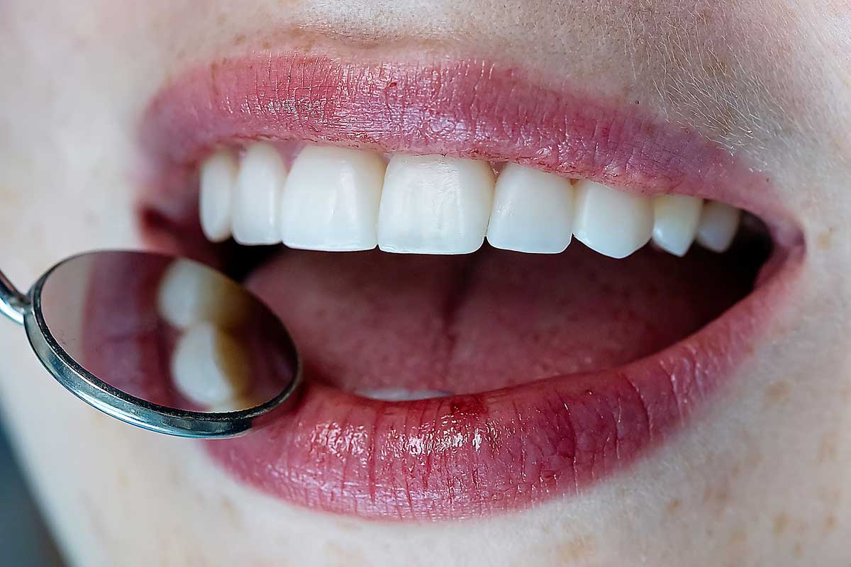 dental implants