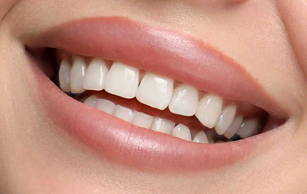 perfect smile