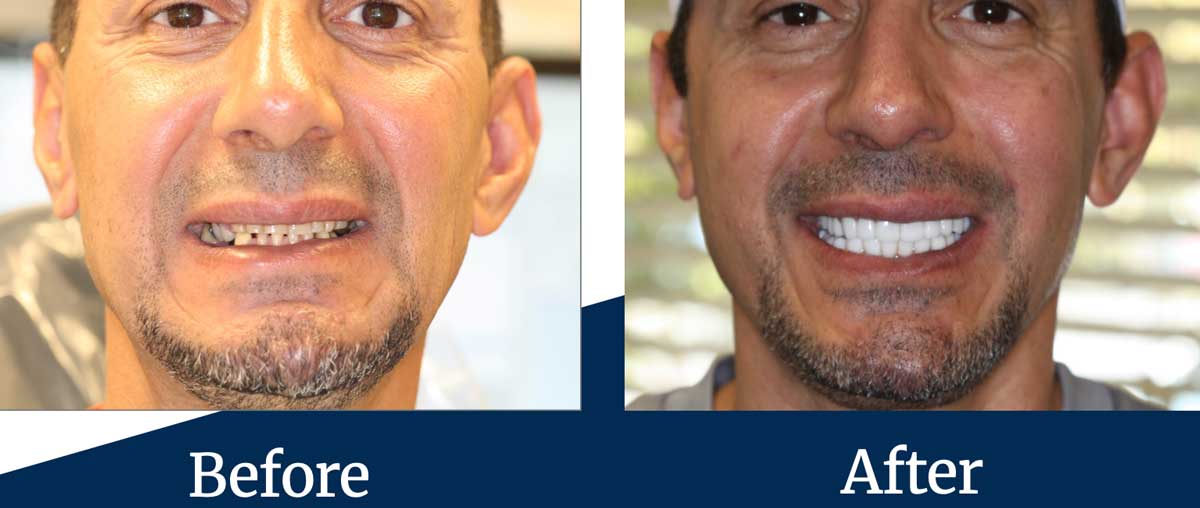 Veneers Before After