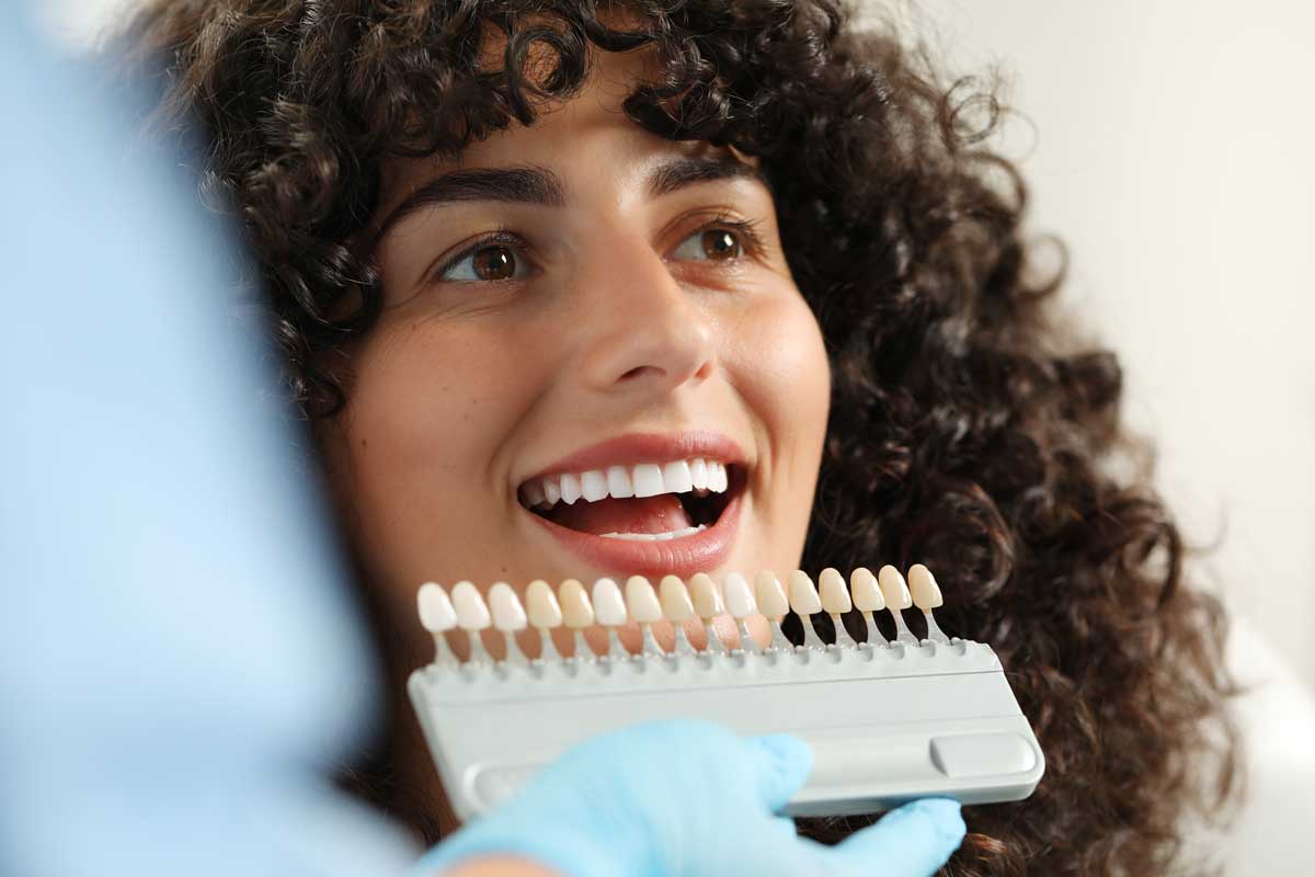 Veneers
